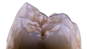Limpieza dental en el sur de Mérida en Dentaly Clínica Dental