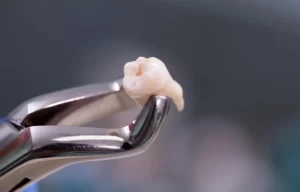 Extracción dental en consultorio dental Mérida