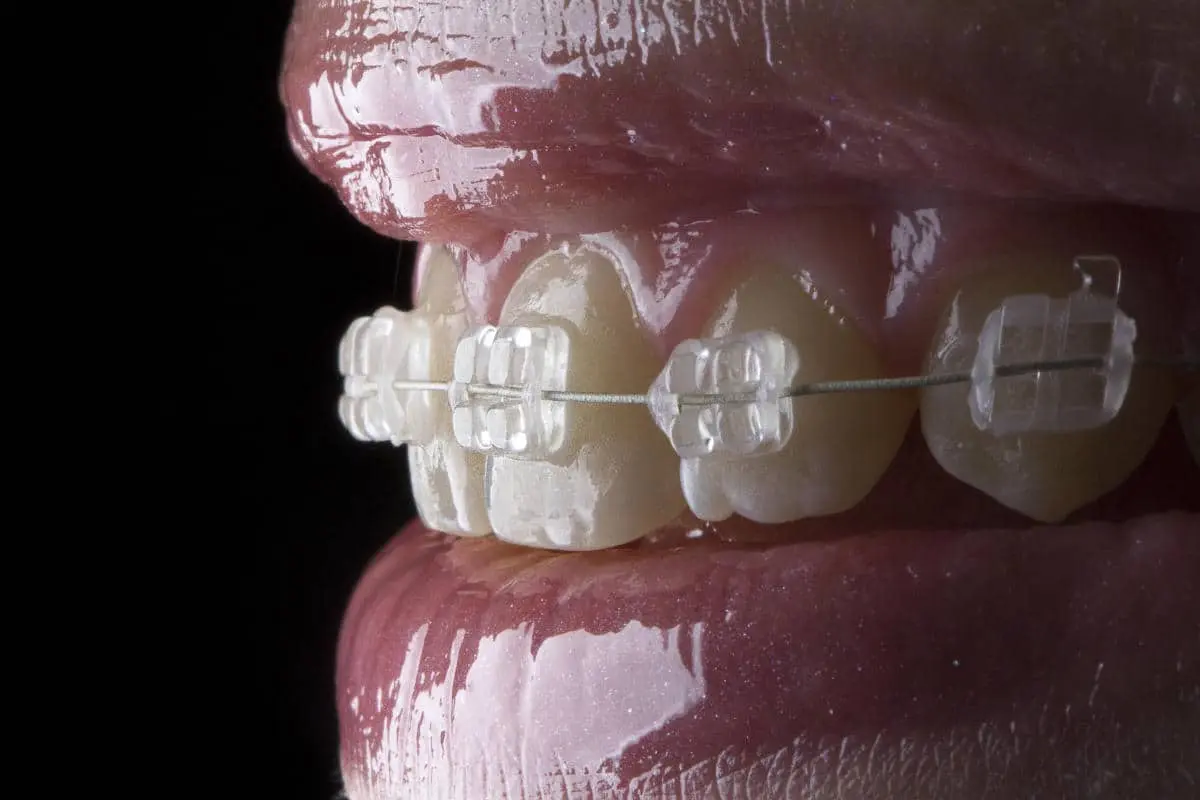 Ortodoncia en Dentaly Clínica Dental Mérida