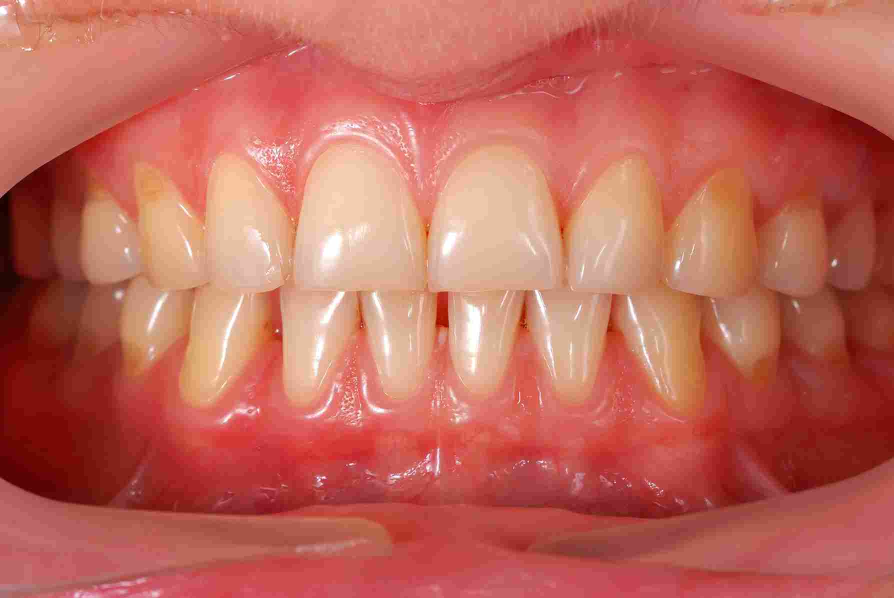 Periodoncia y tratamiento de encías en Mérida