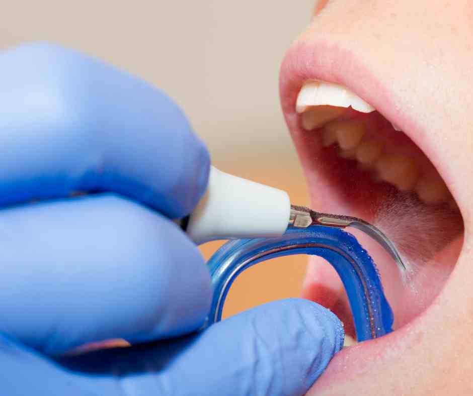 Limpieza dental y prevención en Dentaly Mérida