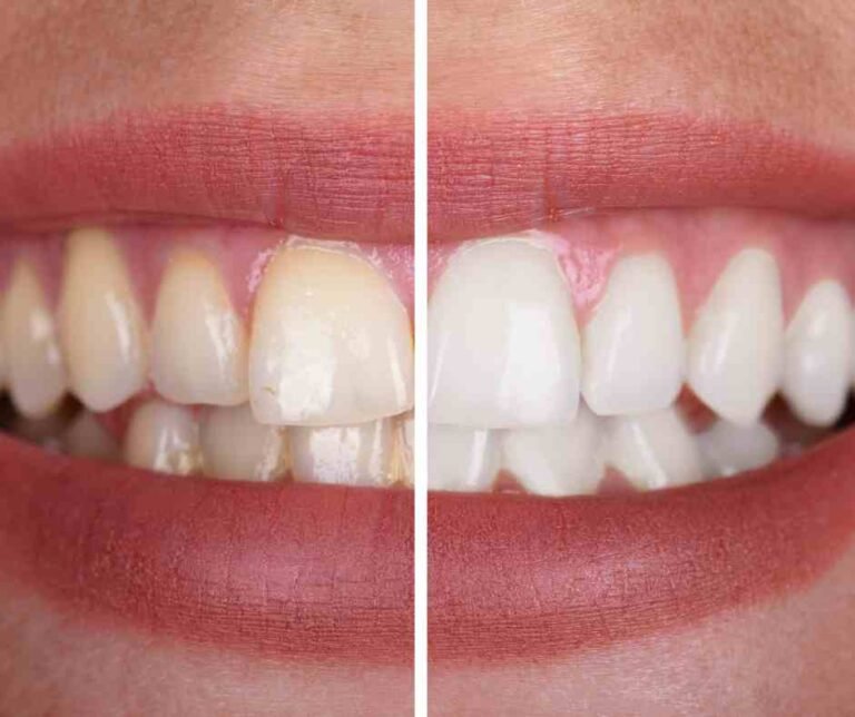 Blanqueamiento dental en Dentaly Clínica Dental Mérida