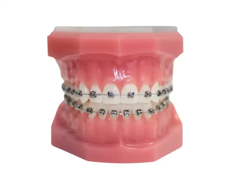 Modelo dental con brackets para ortodoncia en Dentaly Mérida