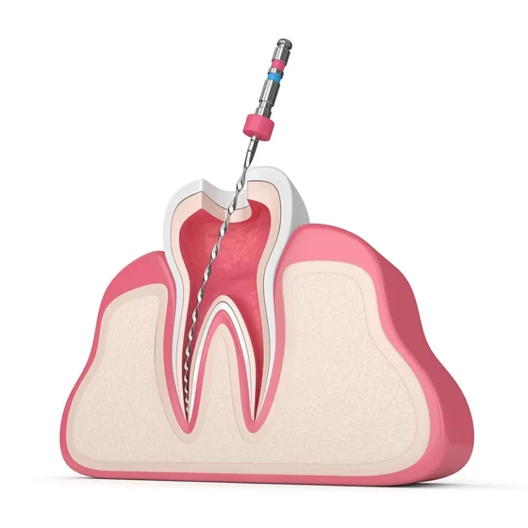 Tratamiento de endodoncia para quitar el dolor dental en Dentaly Mérida