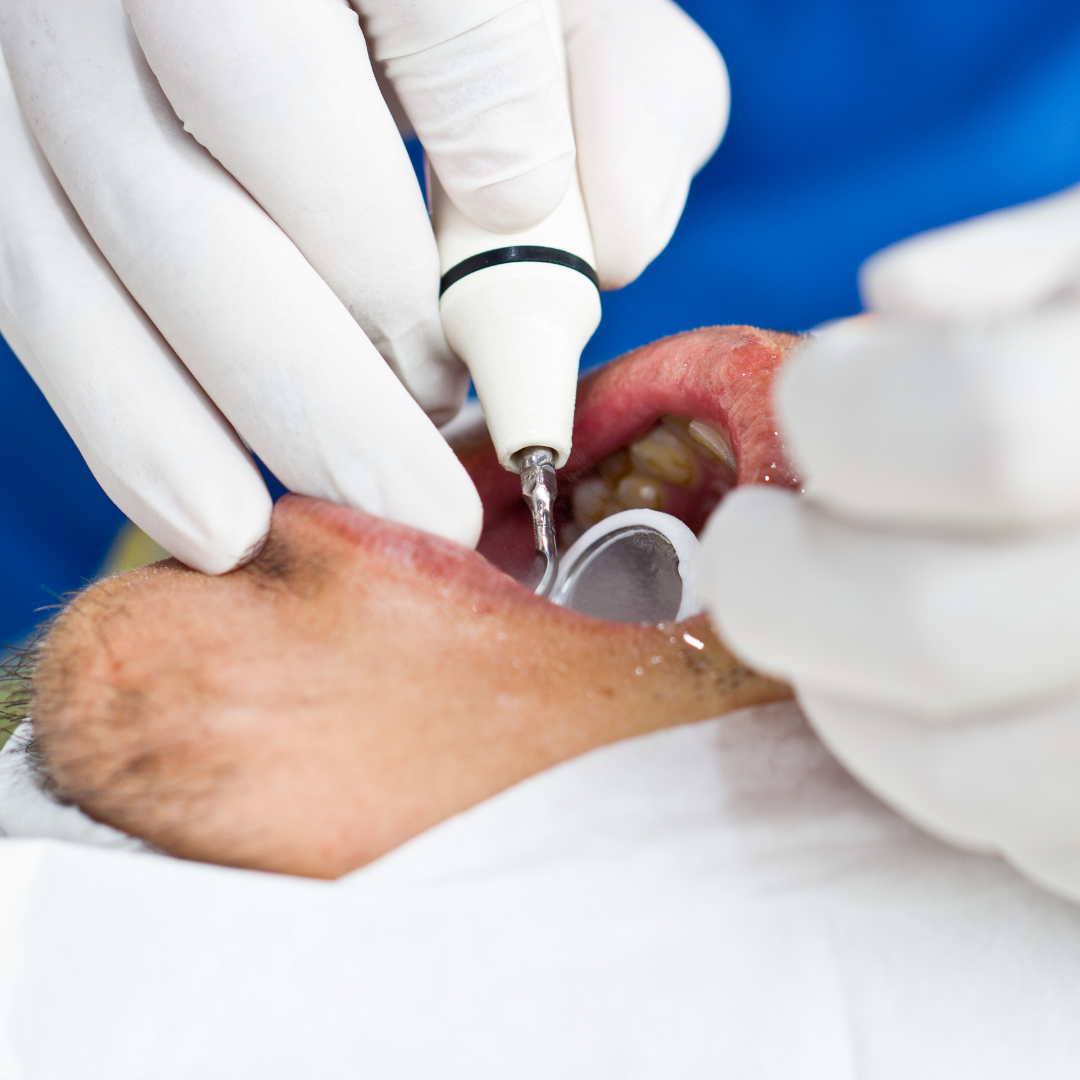 Limpieza dental en Dentaly Clínica Dental Mérida