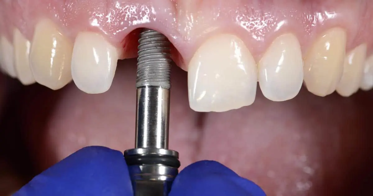 Implantes dentales en Mérida