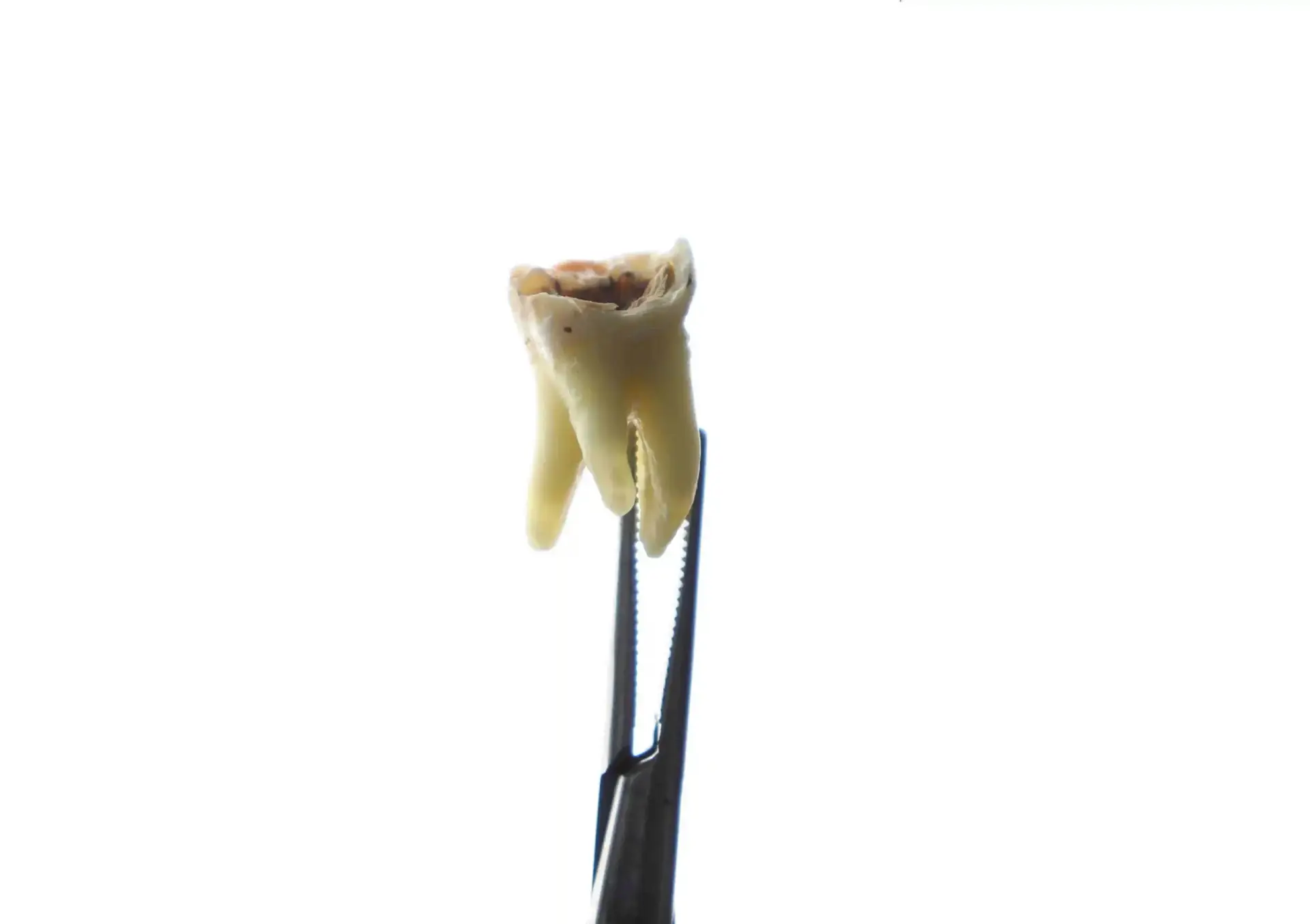 Extracción dental en Dentaly Clínica Dental Mérida