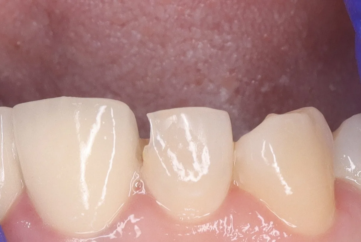 Antes de restauración dental en diente anterior fracturado