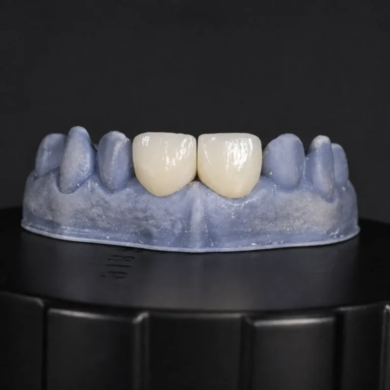 Coronas de zirconia en Dentaly Clínica Dental Mérida