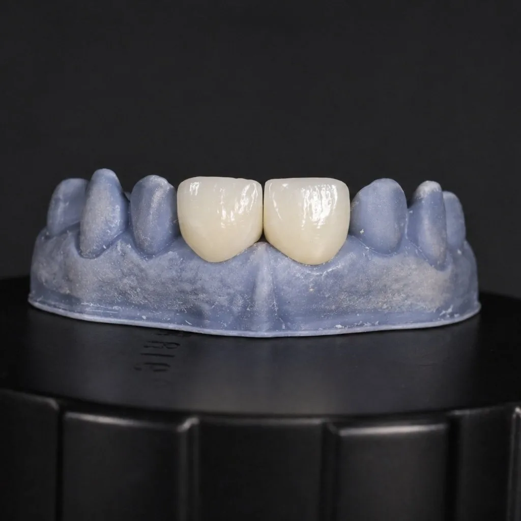 Carillas y estética dental en Mérida
