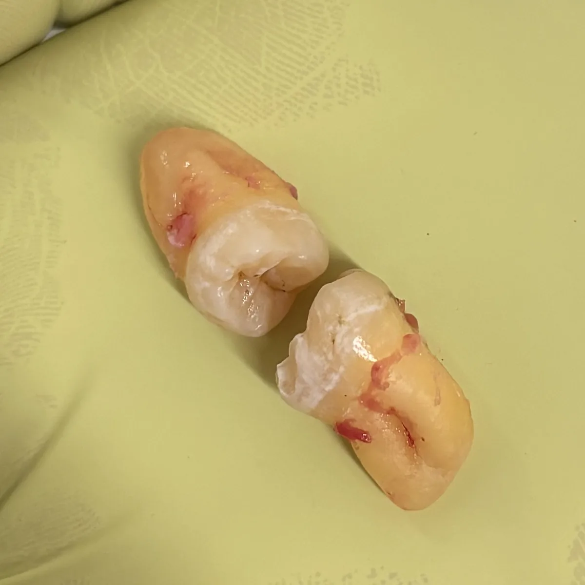 Extracciones dentales y cirugía oral en Dentaly Mérida
