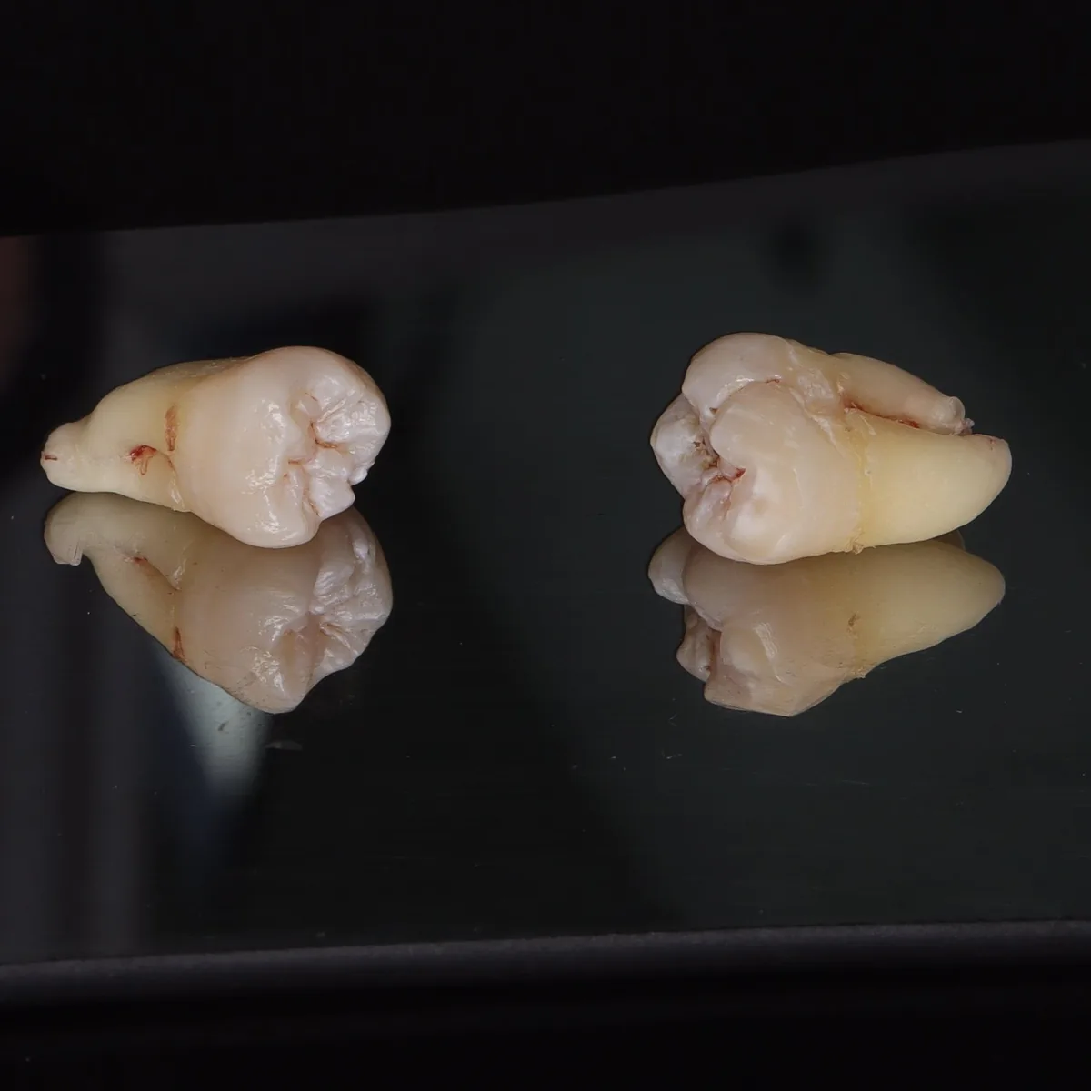 Extracción dental realizada en clínica dental en Mérida