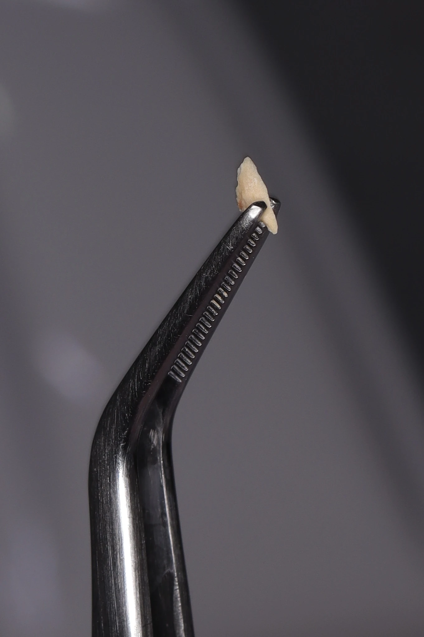 Fragmento de sarro dental retirado durante limpieza dental en Dentaly Mérida