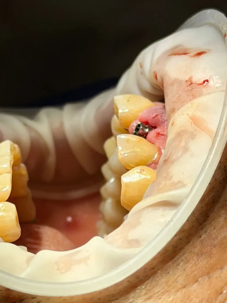 Implantes dentales en Dentaly Clínica Dental Mérida