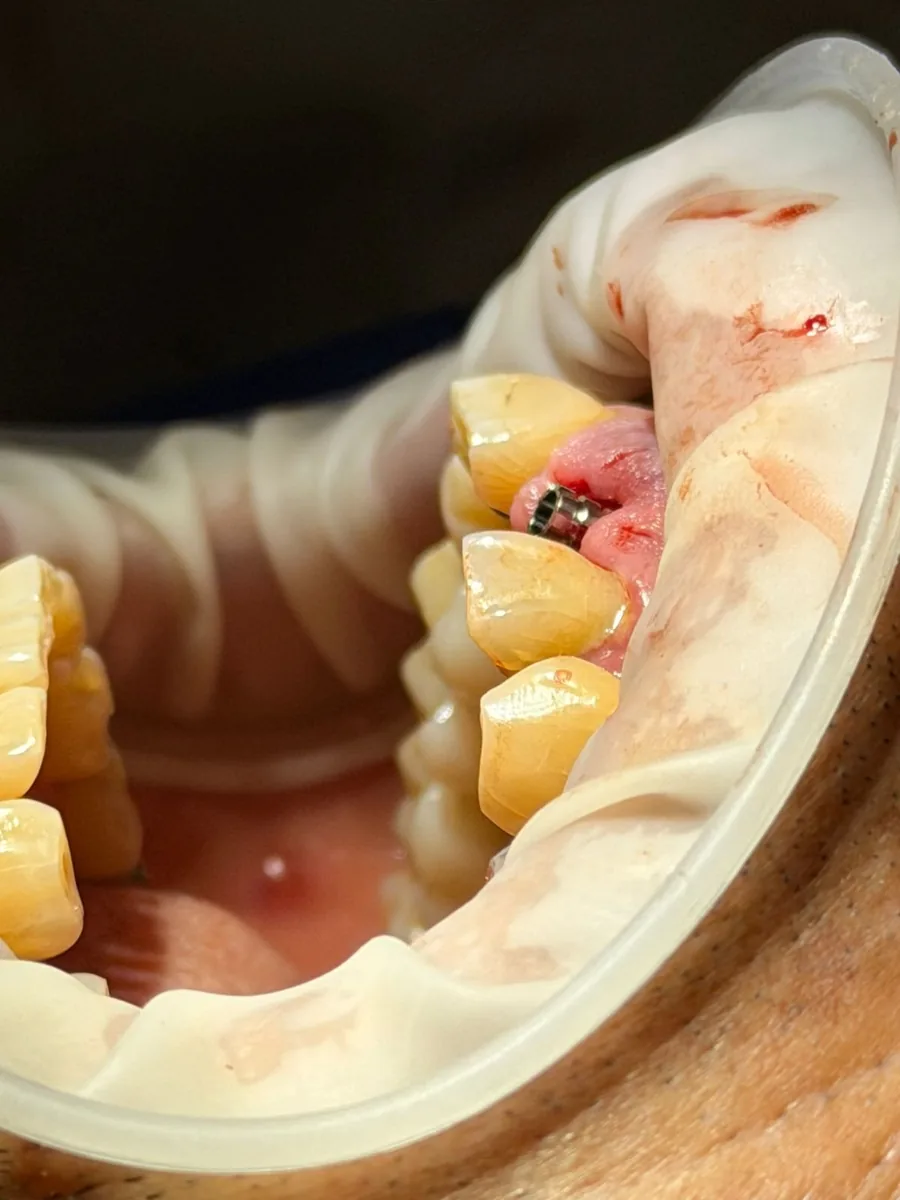 Implante dental en Dentaly Clínica Dental Mérida