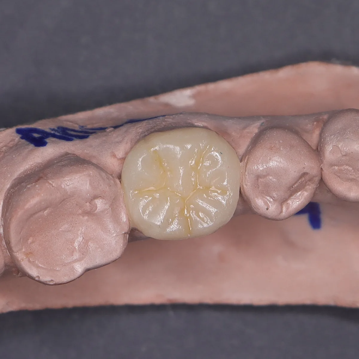 Resina indirecta e incrustación con anatomía dental detallada