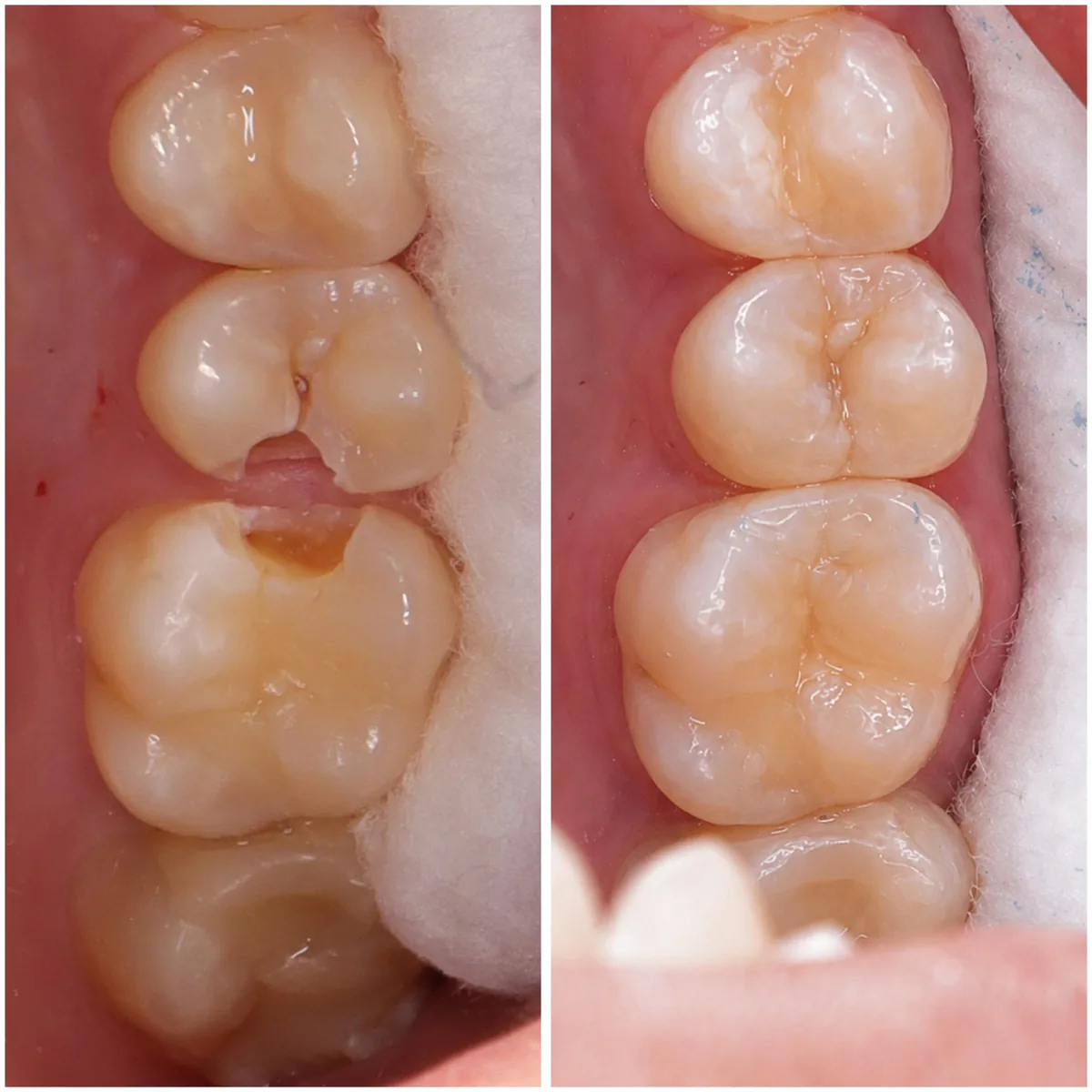 Resinas dentales antes y después en Dentaly Mérida