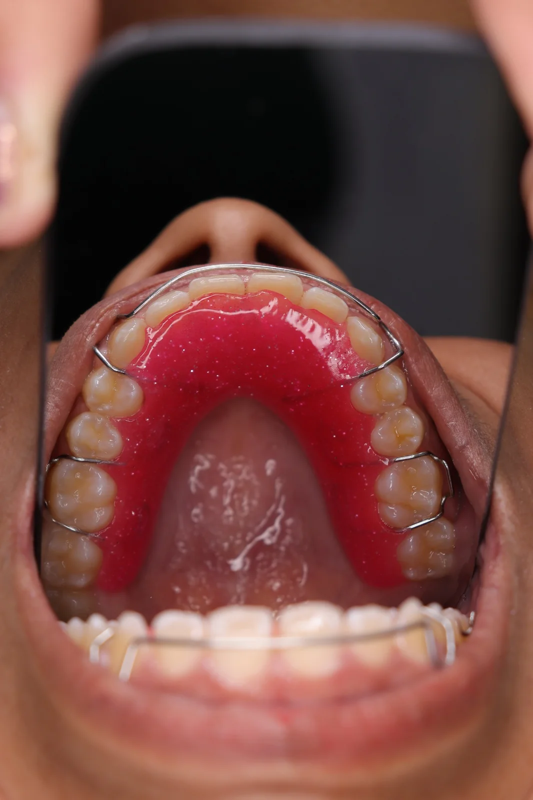 Retenedor de ortodoncia rosa Dentaly Mérida