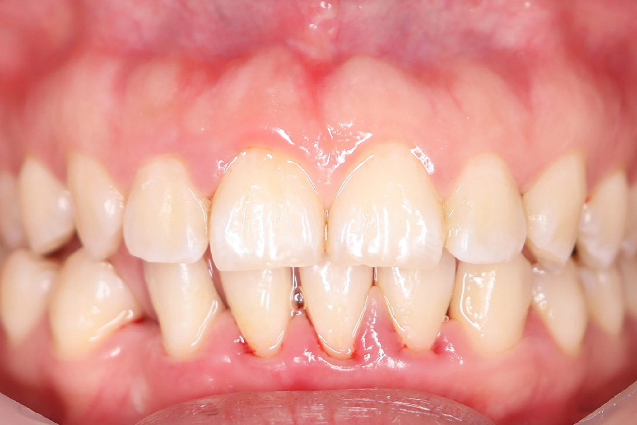 Resultado después de limpieza dental profesional en Dentaly Mérida
