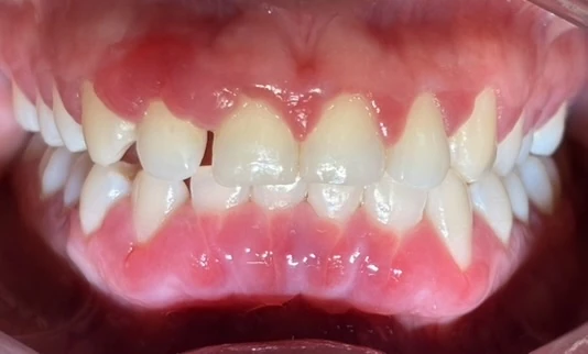 Vista dental frontal usada para explicar acumulación de placa y sarro en Mérida