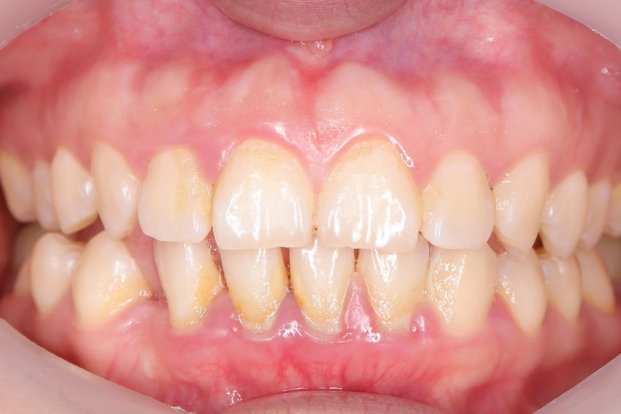 Vista frontal antes de limpieza dental en Mérida con manchas superficiales