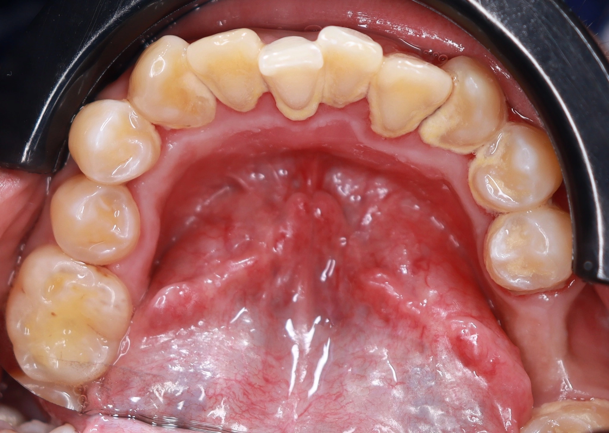Vista oclusal antes de limpieza dental con sarro acumulado en Mérida