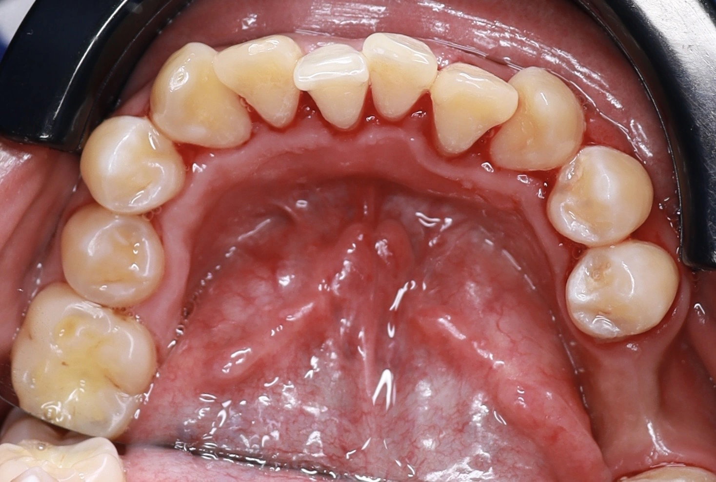 Vista oclusal después de limpieza dental profesional en Mérida