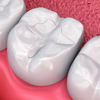 Resina estética en consultorio dental Mérida