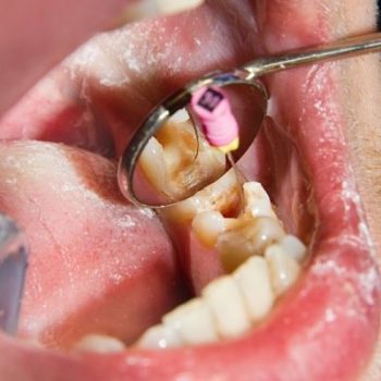 Endodoncia en consultorio dental Mérida