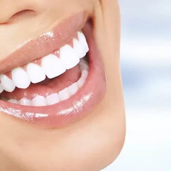 Blanqueamiento dental en consultorio dental Mérida