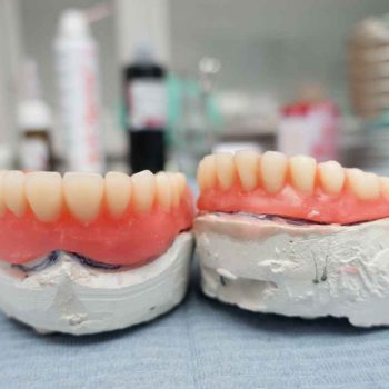Prótesis e implantes en consultorio dental Mérida